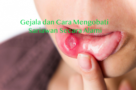 Gejala dan Cara Mengobati Sariawan Secara Alami